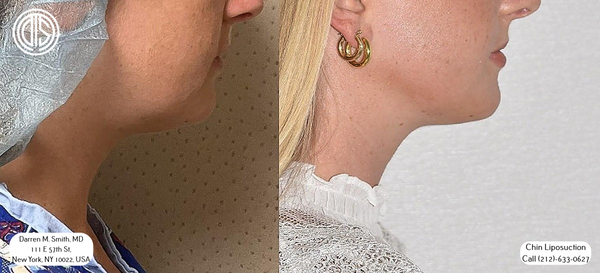 chin liposuction costs in nyc