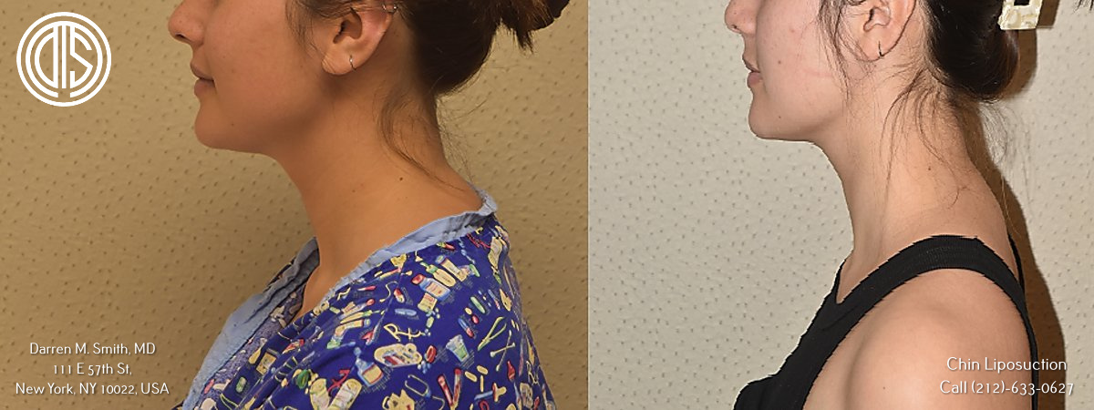 Plastic Surgeon specializing in Chin Liposuction