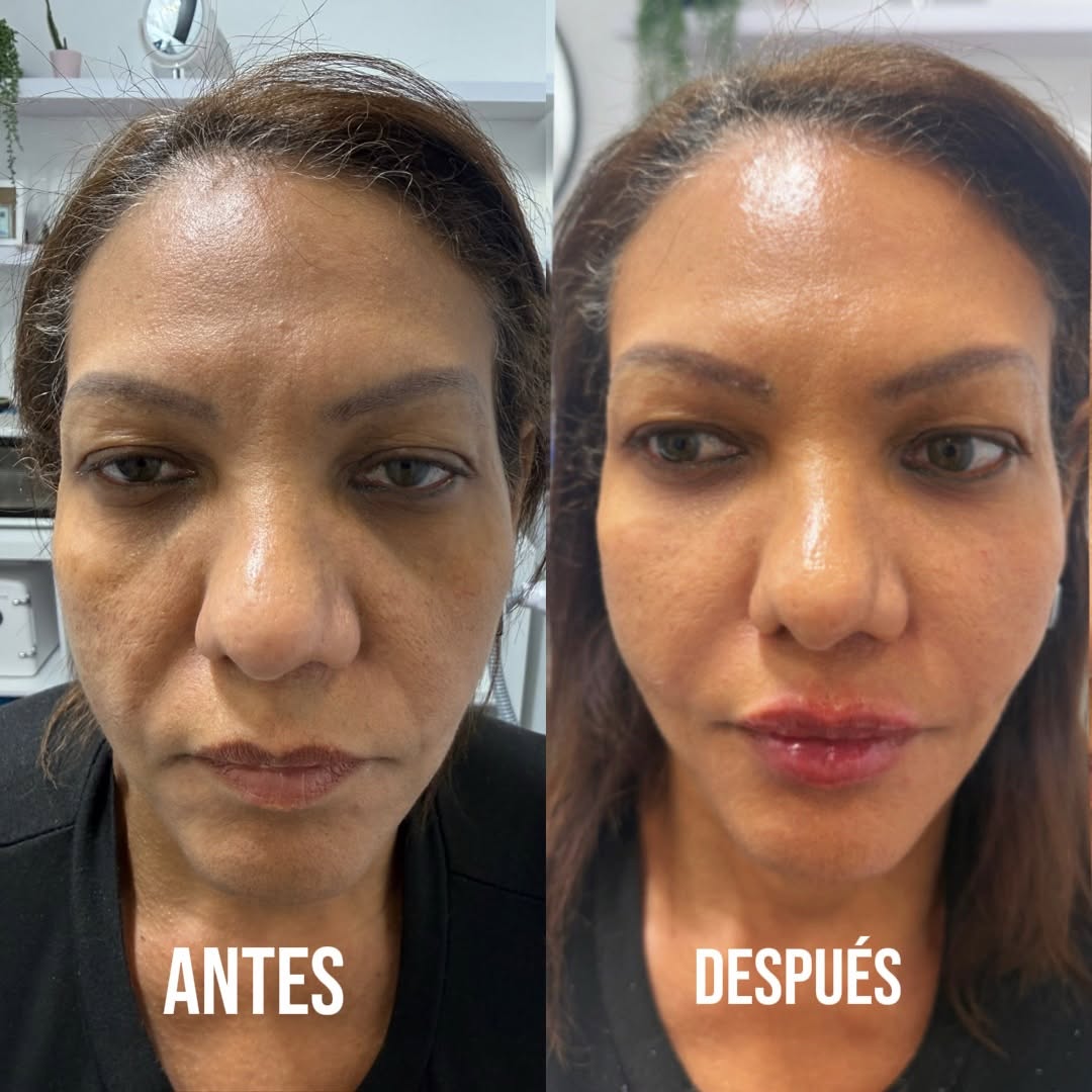 Cristina's Beauty Spa Instagram: No todas las armonizaciones faciales deben verse exageradas…

La verdadera armonización facial no bu…
